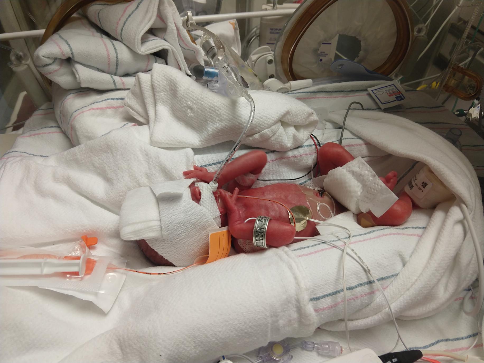 Hannah in NICU